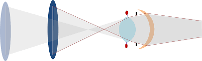 File Plano Focal Alvo Visual Proximo Corrigido Cristalino Png Wikimedia Commons