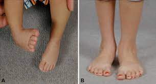 It was released on 17 may 2004 in the uk. The 2017 Abjs Nicolas Andry Award Advancing Personalized Medicine For Clubfoot Through Translational Research Springerlink