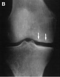 Versatility of the medial femoral condyle flap for extremity reconstruction and identification of risk factors for nonunion, delayed time to union, and complications. A The Medial Femoral Condyle Begins To Flatten 2 To 4 Months After Download Scientific Diagram