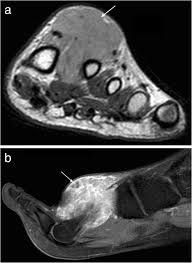 It arises from the base of the fifth metatarsal bone, and from the sheath of the fibularis longus. Mri Imaging Of Soft Tissue Tumours Of The Foot And Ankle Insights Into Imaging Full Text