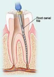 Pin On Fillings And Root Canals