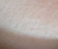 Get information on breast cancer (breast carcinoma) awareness, signs, symptoms, stages, types skin dimpling (peau d'orange). Dimples On Breasts Help