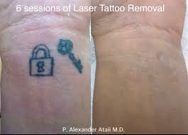 A laser tattoo removal expert can say for sure how many treatment sessions a person needs to after observing it in person. Tattoo Removal San Diego Laser Tattoo Removal La Jolla