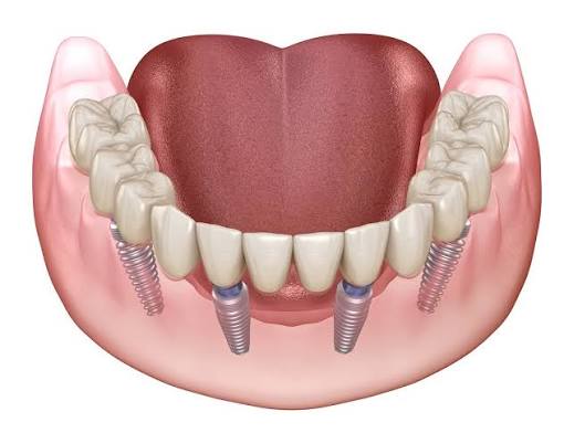 Full Mouth Rehabilitation Wakad