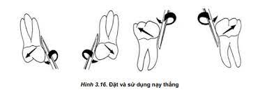 Phương pháp nhổ răng bằng bẩy nha khoa