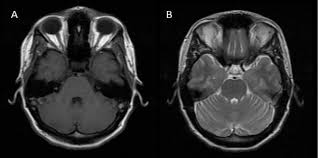 Image result for CT Head