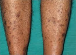 Image result for Pigment stains on the shin