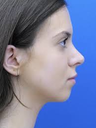 Dorsal Preservation and Narrow Base 6758