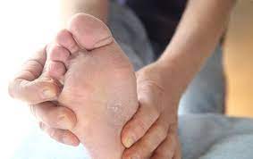 Por Que Se Me Pelan Los Pies Descamacion De Pies Piel En Los Pies
