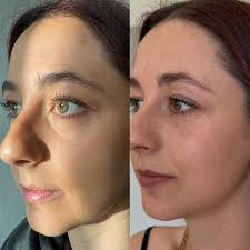 ✨Agradezco mucho cuando mis pacientes me permiten compartir sus historias y  cambios ✨ En este caso, mejoría de ojeras y tercio medio en la primer  paciente, y rinomodelacion sin cirugía en el