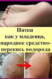 как избавиться от трещин на пятках с помощью перекиси Pyatki Kak U Mladenca Narodnoe Sredstvo Perekis Vodoroda V 2020 G Lichnaya Gigiena Zhurnal O Zdorove Tovary Dlya Zdorovya
