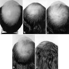 I was first given estradiol cream. Hair Regrowth In A Male Patient With Extensive Androgenetic Alopecia On Estrogen Therapy Journal Of The American Academy Of Dermatology