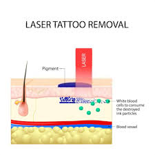 Moreover, these lasers lacked the precision needed to limit risks of permanent damage to the skin. Laser Tattoo Removal Derma Pro Skin Aesthetic Clinic