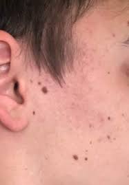 Wie Soll Ich Diese Menge Muttermale Leberflecken Entfernen Lassen Gesundheit Haut Gesicht