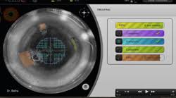 Catalys Precision Laser System Abbott Medical Optics Inc Amo Cataract Surgery Lasik Laser