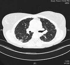 With pneumonitis chronic inflammation of lung tissue can lead to irreversible scarring. Hypersensitivity Pneumonitis A Review And Update Of Histologic Findings Journal Of Clinical Pathology