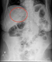 Interpreting An Abdominal X Ray Kub Stepwards