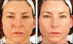 The treatment performed here uses 2 types of dermal filler products. Nasolabial Fold Smile Line Wrinkle Treatment New York City Manhattan