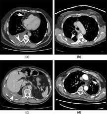 The journal of thoracic disease indicates that not only does mesothelioma show up on a ct scan, but it is the preferred diagnostic tool of choice for advanced stage mesothelioma cases. The Role Of Imaging In Malignant Pleural Mesothelioma An Update After The 2018 Bts Guidelines Clinical Radiology