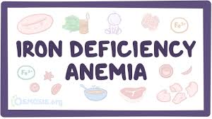 Noticeable heartbeats (heart palpitations) pale skin Iron Deficiency Anaemia Symptoms Cures A Simple Guide