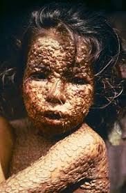 È una malattia infettiva acuta provocata dal variola virus, un virus a dna appartenente della famiglia degli orthopoxvirus. Vaiolo Wikiquote