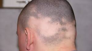 As we get older, hair. Alopecia Characteristics Causes And Treatment