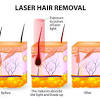 The cost of hair removal treatment in india depends on a range of factors including the body area you are treating, the growth of hair, the technology used, the number of seating required, and the expertise of the dermatologists. 1