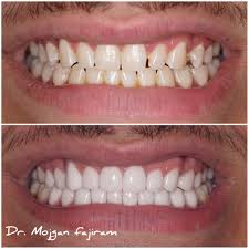 Everyone wants a gorgeous smile. Celebrity Dentist Nyc Sutton Advanced Cosmetic Dentistry