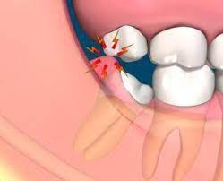 Wisdom Tooth When To And When Not To Remove It Wisdom Teeth Dental Videos Dental Life