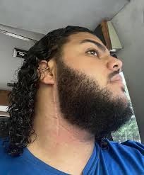 I need to go get my beard trimmed, you can't see my scar anymore.