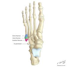 Fractures Of The Proximal 5th Metatarsal Radiology Case Radiopaedia Org Avulsion Fracture Radiology Jones Fracture