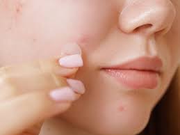 Image result for acne face