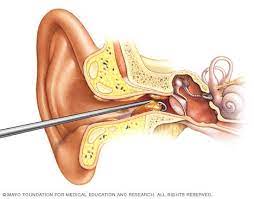 See full list on wikihow.com Earwax Blockage Diagnosis And Treatment Mayo Clinic