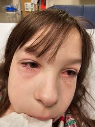 Mycoplasma pneumonia and mirm diagnosis in a child