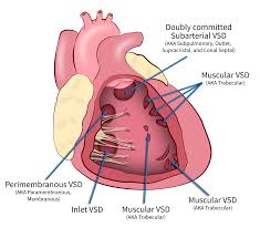 Image result for Ventricular Septal Defect