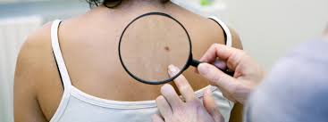 skin cancer — the abnormal growth of skin cells — most often develops on skin exposed to the sun. Skin Cancer Screening Orchard Park Ny Cancer Prevention Dr Peter