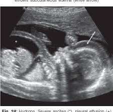 Pleural effusion is classically divided into transudate and exudate based on the light criteria. Figure 24 From Fetal Pleural Effusion Semantic Scholar