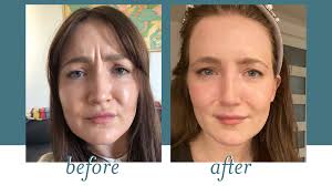 The effects of xeomin usually last for about 3 to 4 months. First Time Xeomin Experience What I Really Think Milk Honey Blog The Partisan Health Skin Hair Care Tipsmilk Honey Blog The Partisan Health Skin Hair Care Tips