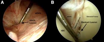 A great use of hagl is when writing in someone's yearbook who you don't plan on seeing over the upcoming summer, or ever again for that matter. Mini Open Repair Of The Floating Anterior Inferior Glenohumeral Ligament Combined Treatment Of Bankart And Humeral Avulsion Of The Glenohumeral Ligament Lesions Sciencedirect