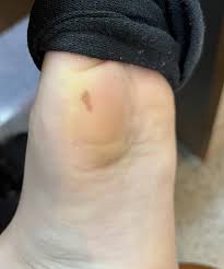 Image result for brown patches on the feet