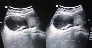 Check spelling or type a new query. Giant Hemorrhagic Ovarian Cyst With Torsion Rare Case Report