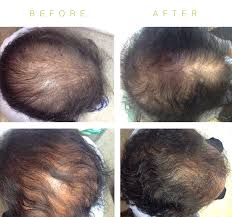 Medications can lead to two types of hair loss: Stop Hair Loss Toskani Cosmetics