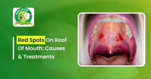 Image result for Physical injury red spots roof of mouth