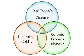 crohns vs ulcerative colitis chart human para foundation