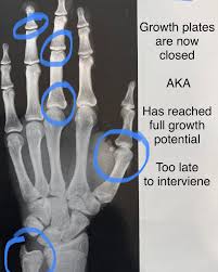 Image result for Hand Growth Plates
