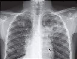 Ptb files are categorized ordinarily as backup files. Pulmonary Tuberculosis Symptoms Causes Pathophysiology Test Treatment And Complications Jotscroll