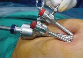 Xerostomia ● the surgical connection between two hollow, or tubular, structures is known as: Journal Of Minimal Acceess Surgery Table Of Contents