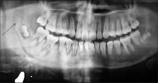 Taken by mouth or injection, they attack any cancer cells in the body. Osteosarcoma Of The Mandible Second Cancer In A Case Of Hodgkin S Lymphoma Post Chemotherapy De S Ghosh S Mondal D Sur Pk J Can Res Ther