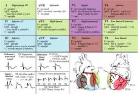 Pretty Ekg Chart Critical Care Nursing Nursing Students