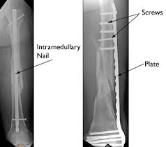 femur shaft fractures broken thighbone